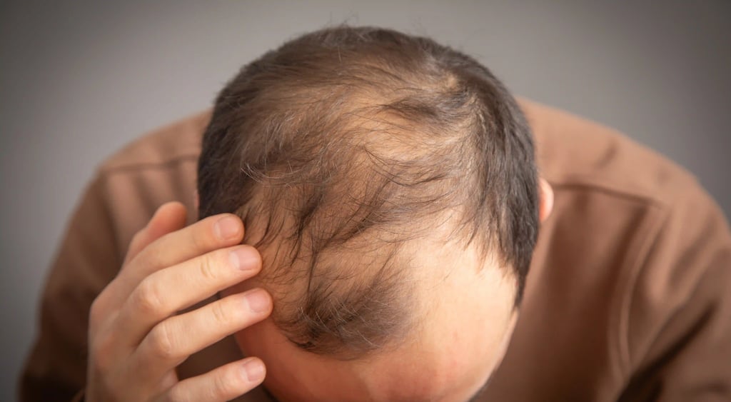 Does Cannabis Cause Hair Loss? Here's What Research Says